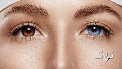 جراحی تغیی رنگ چشم - رنگ عنبیه