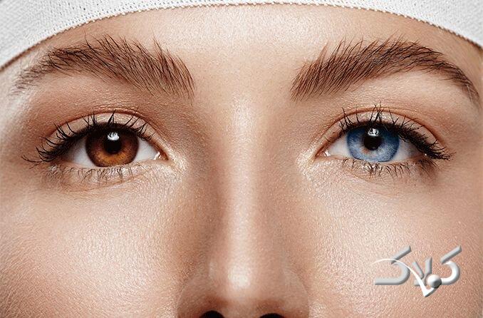 جراحی تغیی رنگ چشم - رنگ عنبیه