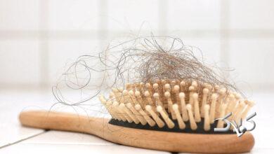 ریزش مو - hair loss - ریزش مو در مردها