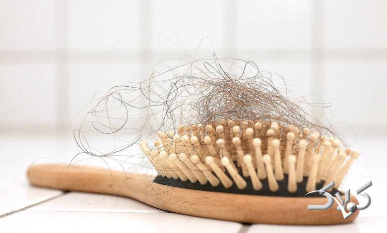 ریزش مو - hair loss - ریزش مو در مردها