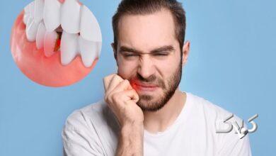 بهداشت دندان - دندانپزشکی - پوسیدگی دندان