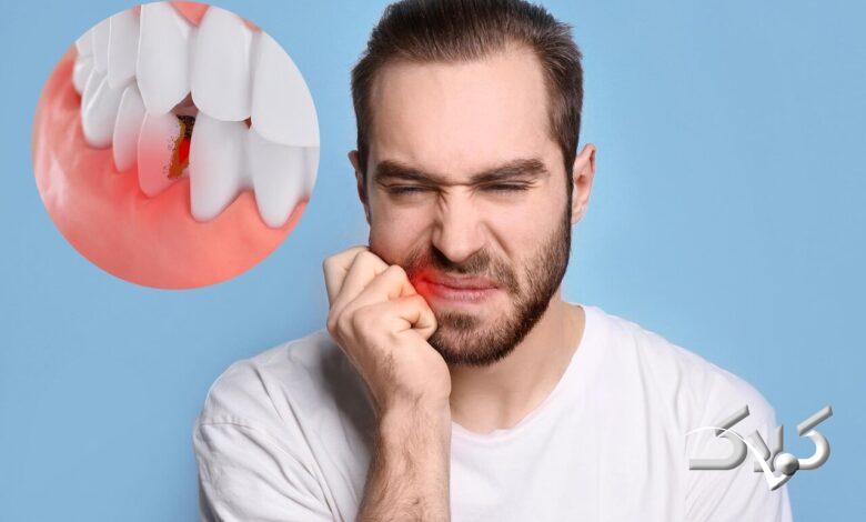 بهداشت دندان - دندانپزشکی - پوسیدگی دندان