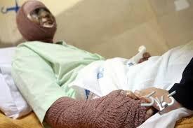 هزینه سوختگی