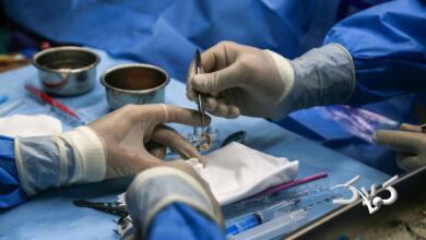 پیوند قرنیه