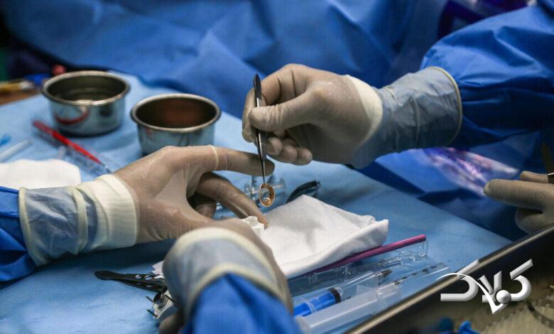 پیوند قرنیه