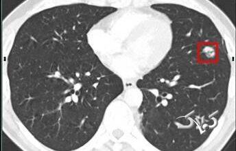 lung cancer