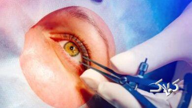 پیوند قرنیه