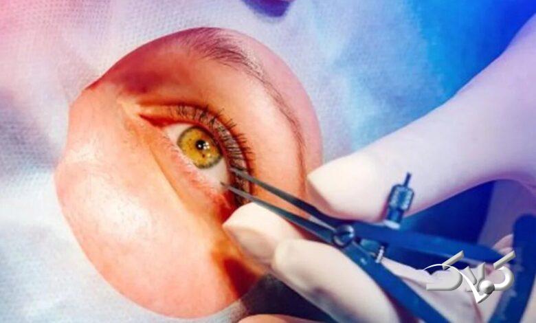 پیوند قرنیه