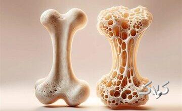 ویتامینهای مفید برای تقویت استخوان