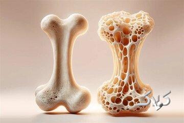 ویتامینهای مفید برای تقویت استخوان