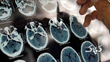 ۵ علامت هشدار دهنده پیری زودرس مغز