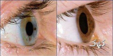 آیا استفاده مداوم از موبایل و لپ‌تاپ باعث قوز قرنیه می‌شود؟