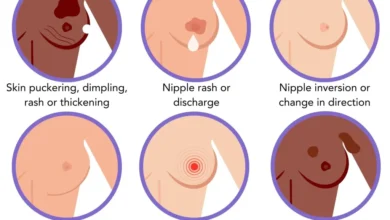 علائم سرطان سینه