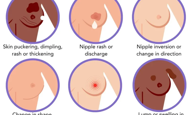 علائم سرطان سینه