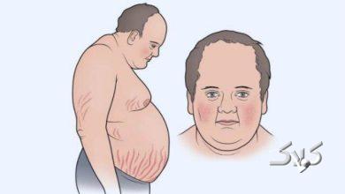 سندرم کوشینگ