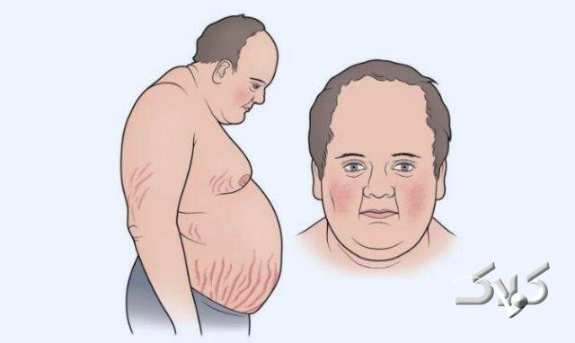 سندرم کوشینگ