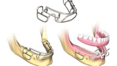 ایمپلنت ساب پریوستئال در کلینیک دندانپزشکی مدرن