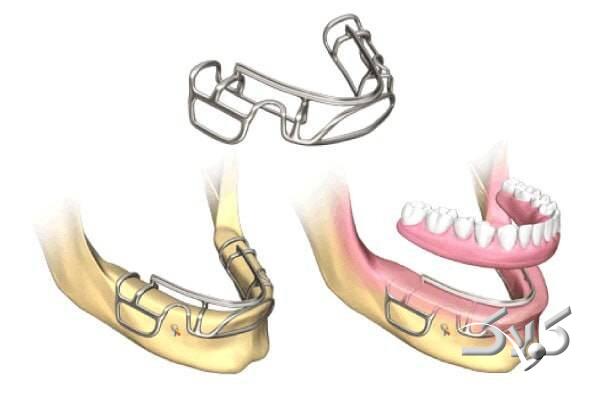 ایمپلنت ساب پریوستئال در کلینیک دندانپزشکی مدرن