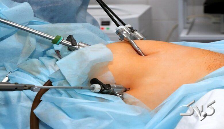 کدام روش جراحی چاقی بیشترین میزان کاهش وزن را تضمین میکند؟