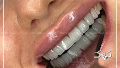 چطور کامپوزیت دندان در کمتر از یک جلسه لبخندتان را تغییر میدهد؟