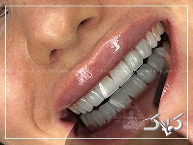 چطور کامپوزیت دندان در کمتر از یک جلسه لبخندتان را تغییر میدهد؟