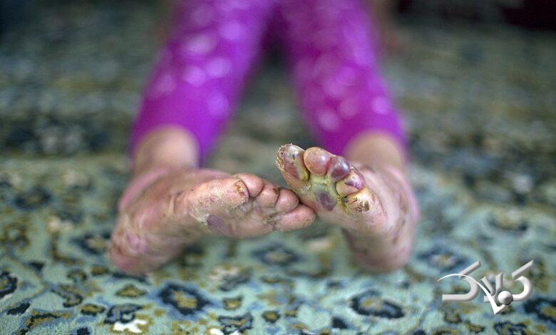 بیماران پروانهای