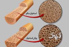 پوکی استخوان