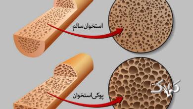 پوکی استخوان