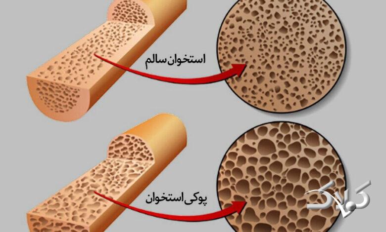 پوکی استخوان