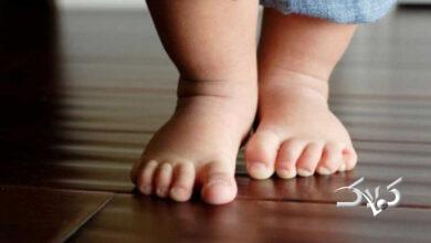 کف پای صاف در کودک