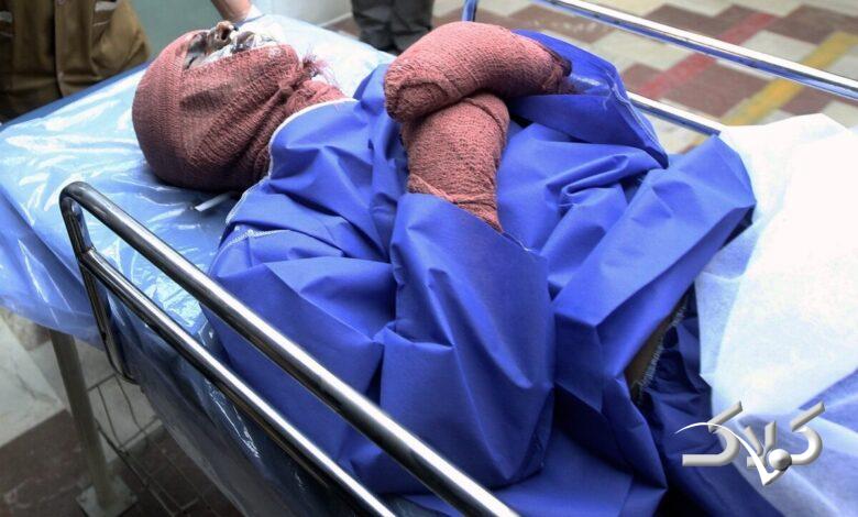 سوختگی - اسیدپاشی