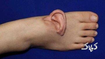 نجات لاله گوش زن چینی با پیوند موقت روی پا