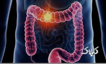 علائم گوارشی را ساده نگیرید/ هر خونریزی هموروئید نیست