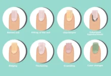 مشکلات مختلف ناخن