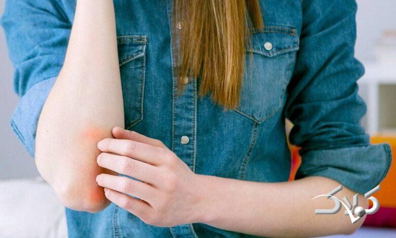 بیماری پوستی پسوریازیس