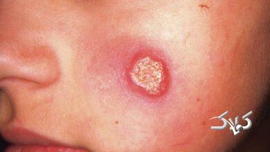 بیماری سالک