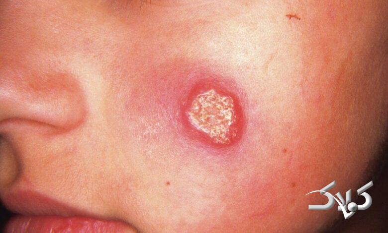 بیماری سالک