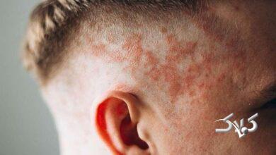 اگزمای پوست