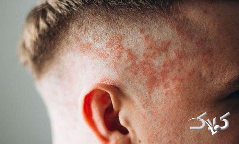 اگزمای پوست