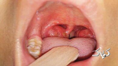 التهاب لوزه در کودکان و راههای درمان آن