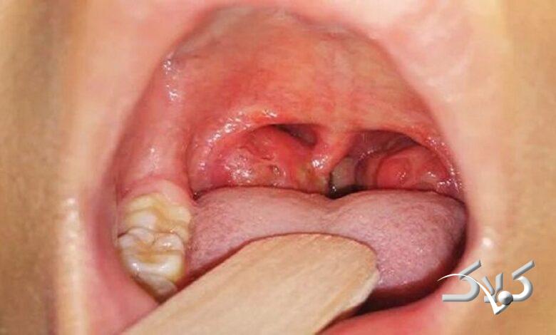 التهاب لوزه در کودکان و راههای درمان آن