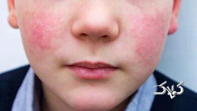 لوپوس در کودکان