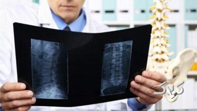 پوکی استخوان