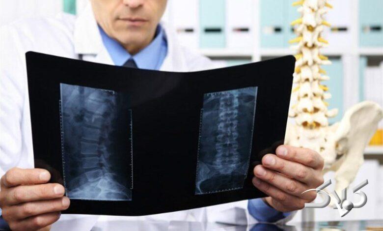 پوکی استخوان