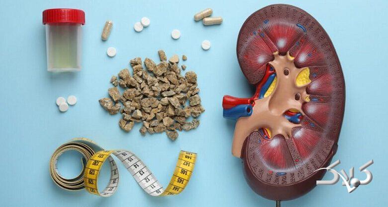 سنگ کلیه 2