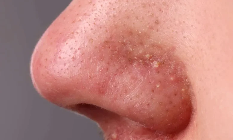 جوش روی بینی