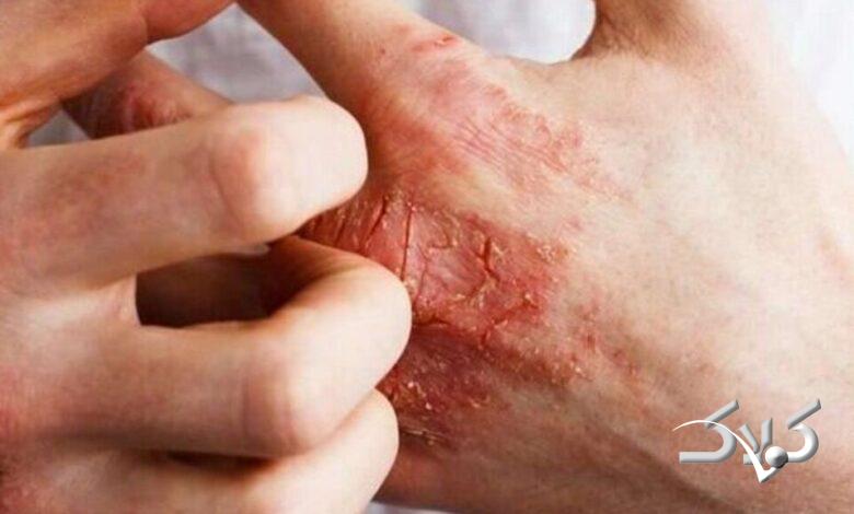 حساسیت پوستی - آلرژی