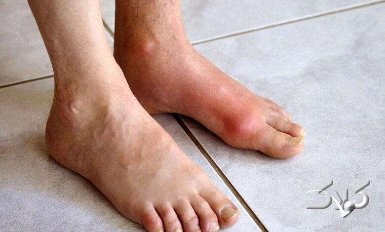 نقرس