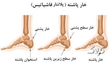 خار پاشنه