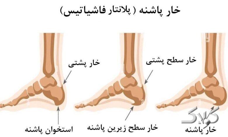 خار پاشنه
